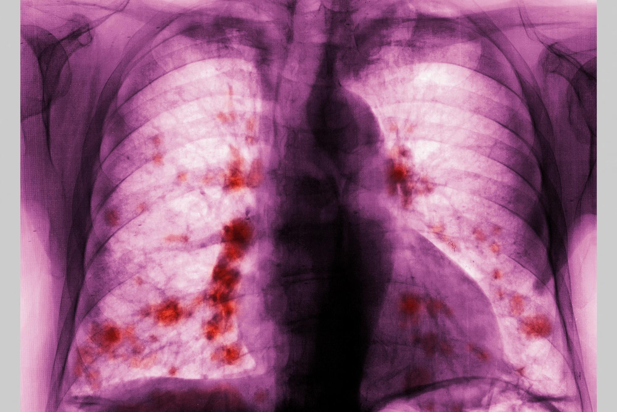 Lung metastases Pulmonary metastases (secondary to kidney cancer), visualized by a frontal chest X-ray. (Photo by CAVALLINI JAMES / BSIP / BSIP via AFP)