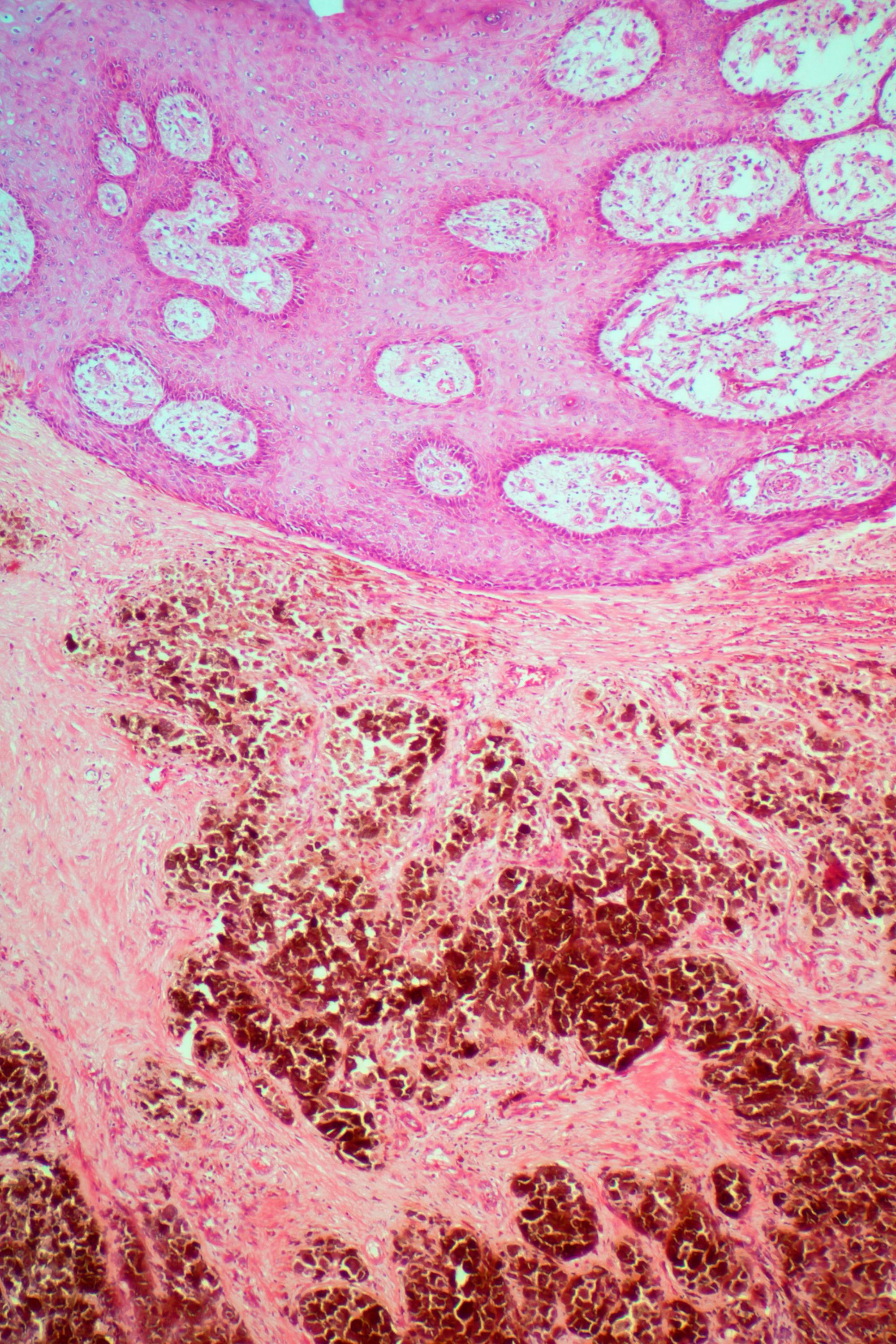 Malignant melanoma. Light micrograph (LM) of a section through human skin showing melanoma cancer (brown bottom of image). The skin epithelium is at the top of the image.This cancer arises from the skin's melanocytes, the cells that produce the pigment (melanin) that give skin its colour.The main cause of melanoma is exposure to ultraviolet radiation in sunlight. It is an aggressive cancer that often spreads (metastasises) to other tissues of the body. Treatment is with surgical removal of the tumour, often combined with chemotherapy and/or immunotherapy. However, once the cancer has spread, the prognosis is poor. Magnification: x 25 when printed 10cm wide.