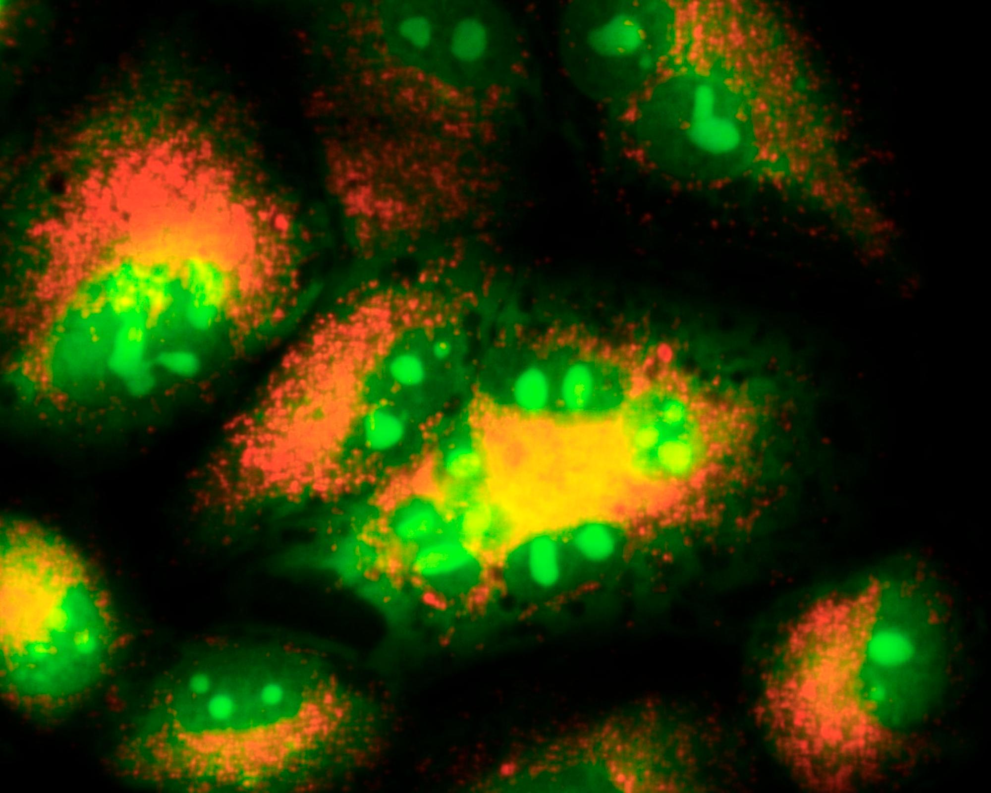Lung cancer autophagy. Fluorescence light micrograph of lung cancer cells in a case of autophagy (autophagocytosis). This is the natural mechanism that destroys unnecessary or dysfunctional cellular components. This can occur as part of a cancer cell's response to chemotherapy and radiation, and it may also affect the resistance of a cancer to therapy. These cells are H460 non-small cell lung cancer cells. They were exposed to the anti-tumour drug etoposide. The H460 cells contain acidic autophagic vacuoles (orange) that are outside the cell nuclei. The small bright green bodies are probably micronuclei.
