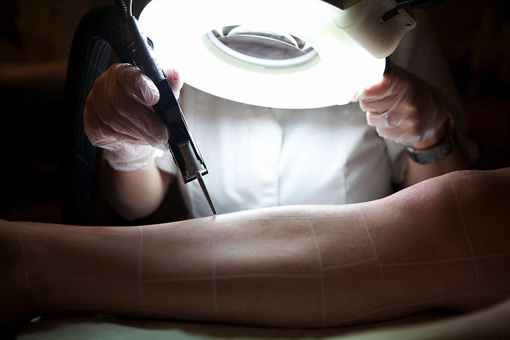 Laser Hair Removal (Photo by: BSIP/Universal Images Group via Getty Images)