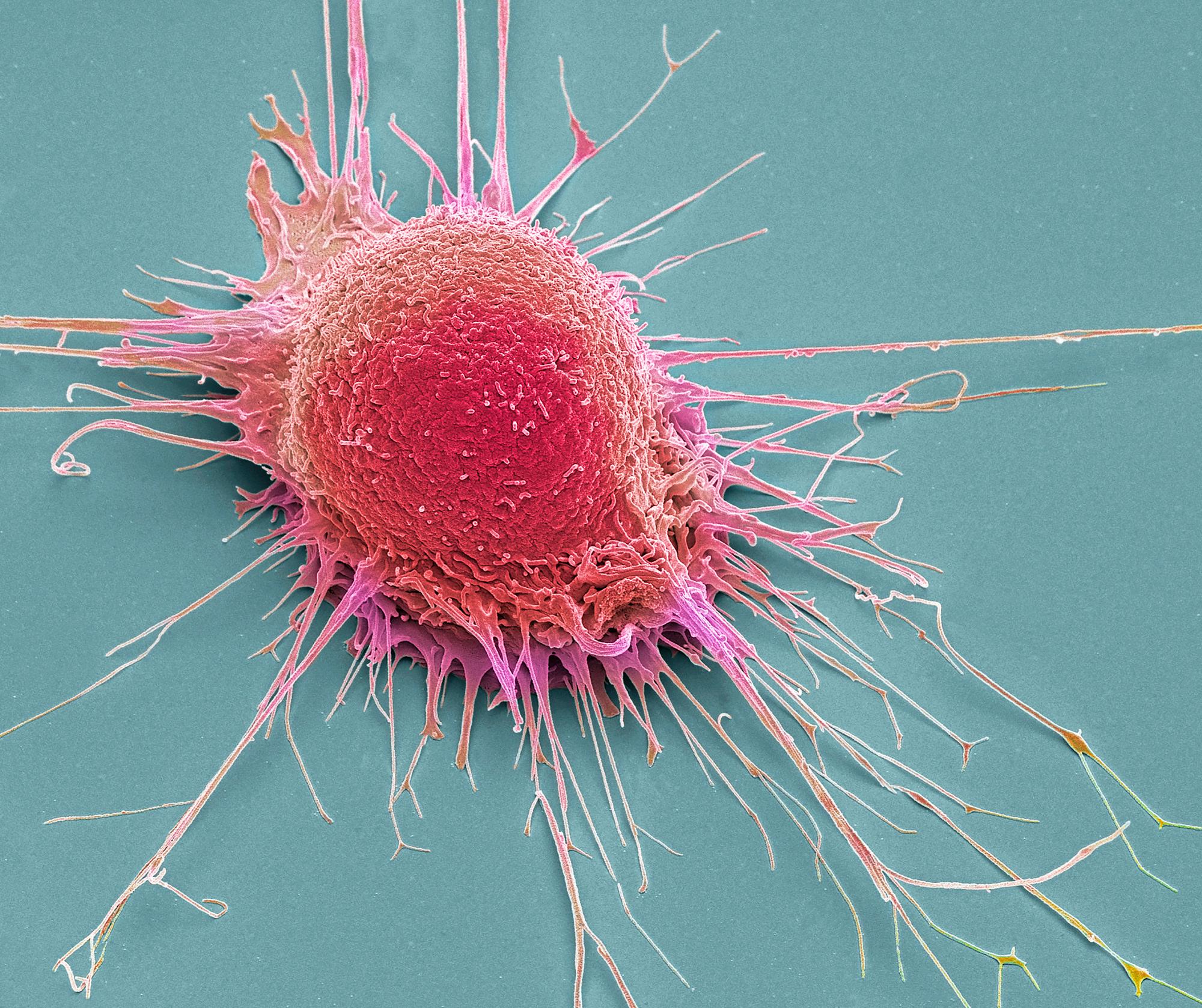 Prostate cancer cell, coloured scanning electron micrograph (SEM). Such cells can clump to form tumours, which often invade and destroy surrounding tissues. The prostate is a small gland found in men just below the bladder, surrounding the urethra, the tube urine passes through. Prostate cancer is most prevalent in men over 50 years of age. Treatment is with hormone therapy, chemotherapy, or surgical removal of the prostate. Magnification: x 3000 when printed at 10 centimetres across.