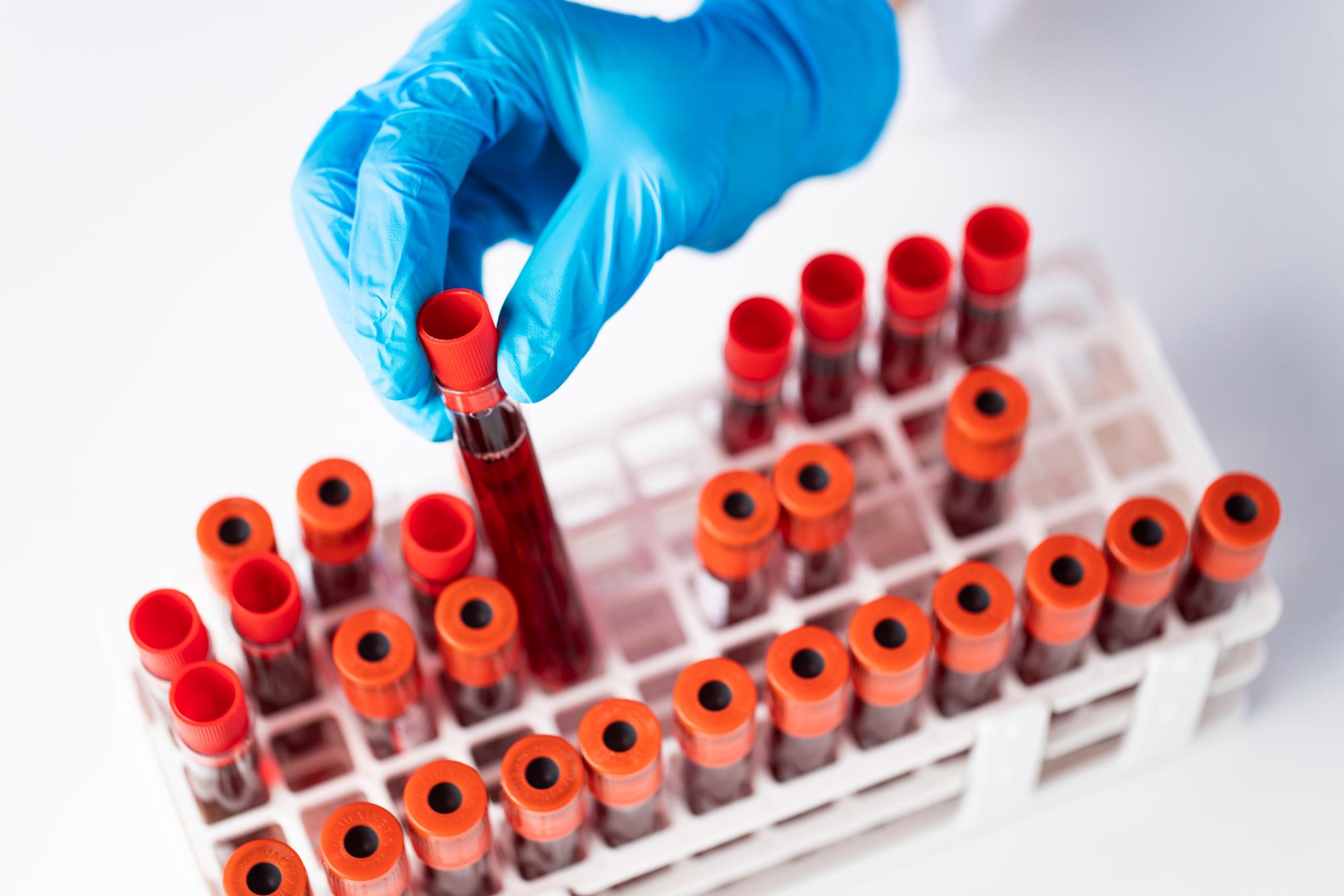 Doctor hand taking a blood sample tube from a rack in the lab